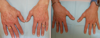 Hands - Fat Transfer