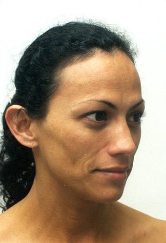 endoscopic brow-lift, upper and lower lid blepharoplasty, septorhinoplasty and lipo transfer to the midface area