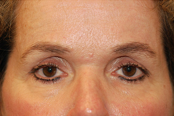 Fat Grafting/Eyelid Surgery