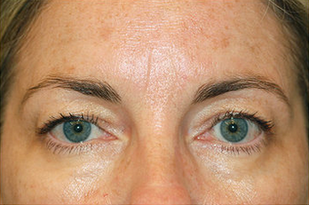 Eyelid Surgery/Fat Transfer
