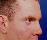 Facial Fat Grafting