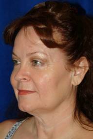 Fascial fat grafting with facelift
