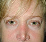 Fat transfer and Skin resurfacing