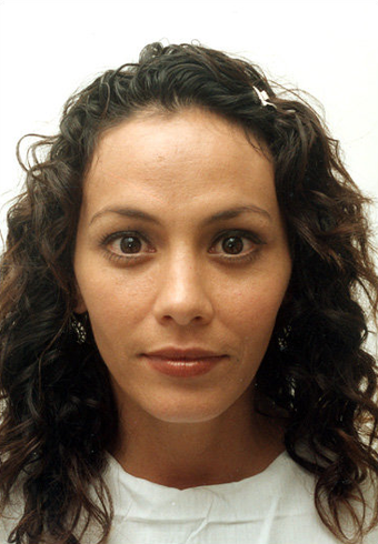 endoscopic brow-lift, upper and lower lid blepharoplasty, septorhinoplasty and lipo transfer to the midface area