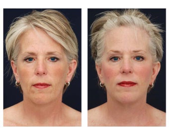 Neck Lift, Fat Grafting