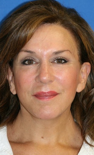 Fat Transfer & Facelift