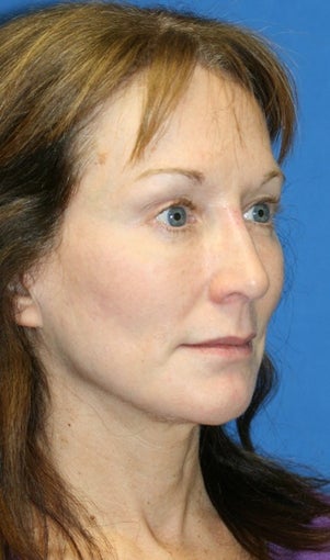 Facelift and Fat Transfer