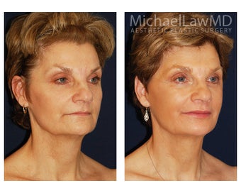 Facial Rejuvenation - Fat Transfer