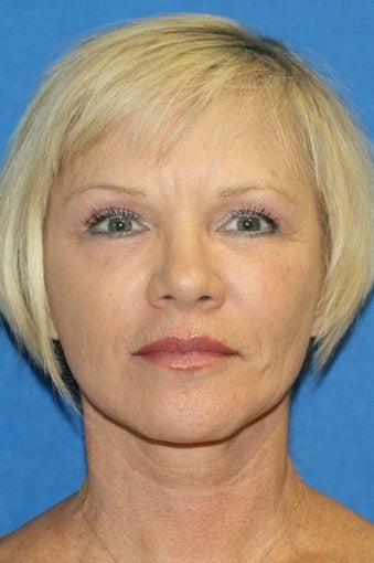 Facelift, Fat Transfer, and Skin Pinch