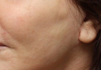 Fat Transfer to Cheeks