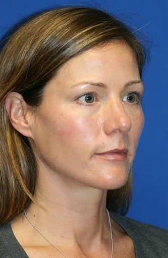 1 month post op: Full Face Fat Transfer