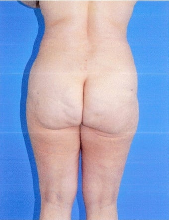 Liposuction