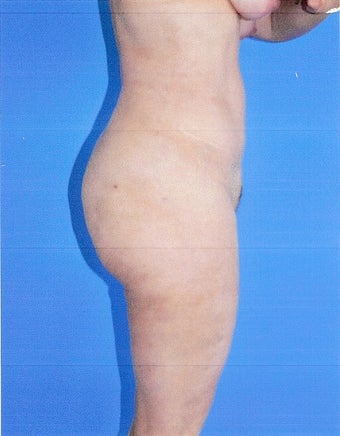Liposuction