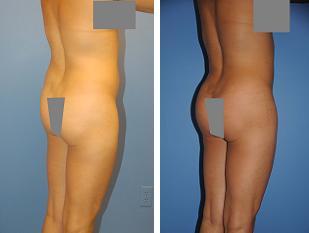 Fat Transfer 