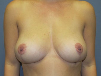 Breast Reduction, Fat Transfer