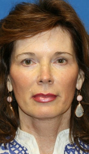 Facelift, Fat Transfer, and Skin Pinch