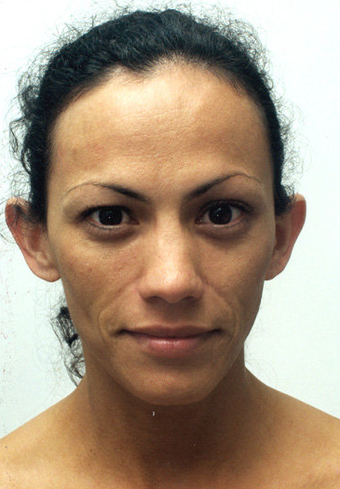 endoscopic brow-lift, upper and lower lid blepharoplasty, septorhinoplasty and lipo transfer to the midface area
