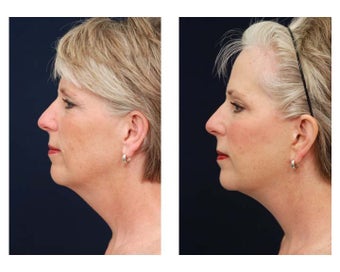 Neck Lift, Fat Grafting