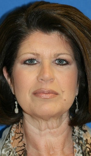 Fat Transfer & Facelift