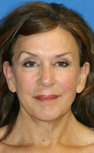 Fat Transfer & Facelift