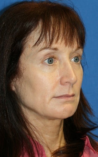 Facelift and Fat Transfer