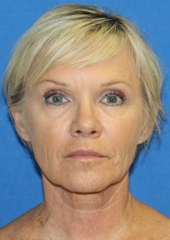Facelift, Fat Transfer, and Skin Pinch
