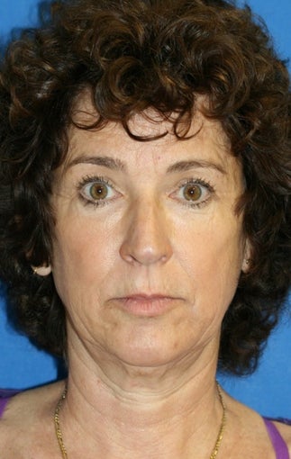 Facelift, Lateral Browlift, Fat Transfer, Chemical Peel