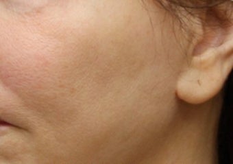 Fat Transfer to Cheeks