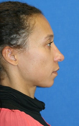 Full Face Fat Transfer