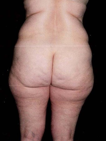 Liposuction