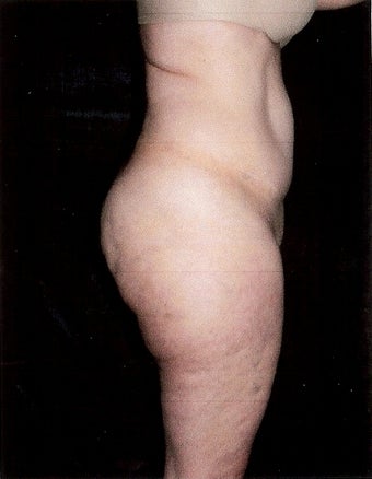 Liposuction