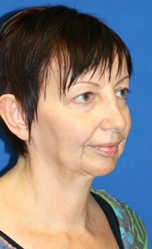 Facelift, Fat Transfer, Upper Bleph, Lower Eyelid Skin Pinch