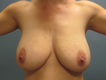 Breast Reduction, Fat Transfer