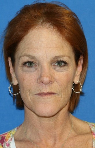 Facelift with Extended Necklift, Fat Transfer, and Skin Pinch