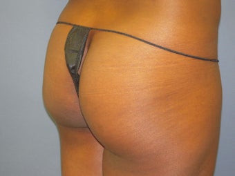 Fat Transfer