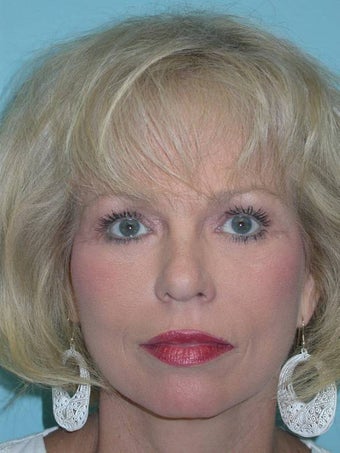 Full Facial Rejuvenation