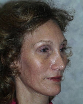 Endoscopic Forehead Lift