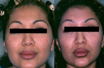 Brow and Forehead Lift
