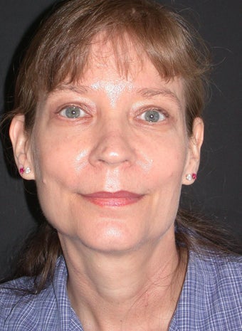 Endoscopic forehead lift, Upper and Lower Blepharoplasty