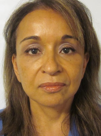 Forehead Lift