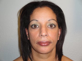 Forehead Lift