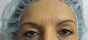 Forehead Lift/ Quad Blepharoplatsy