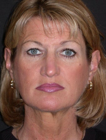 Endoscopic forehead lift