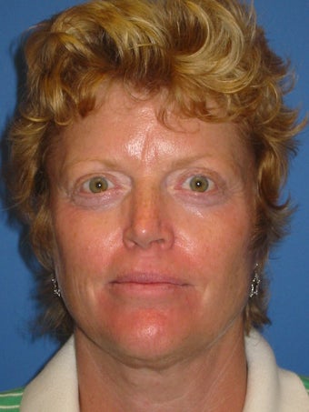 Browlift