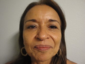 Forehead Lift