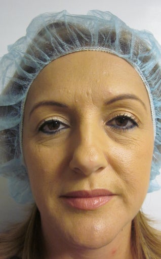 Forehead Lift/ Quad Blepharoplatsy