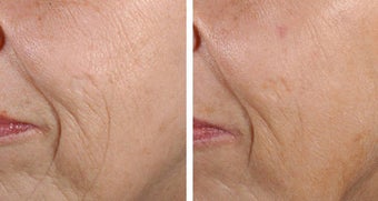  Fractional Skin Resurfacing Before and After Fractional Skin Resurfacing