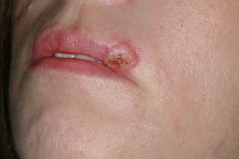 Dog bite repair