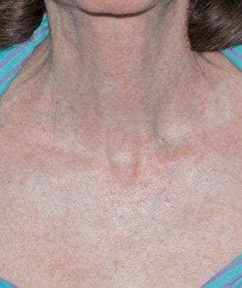 Fractional CO2 Laser Treatment