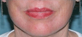 Fractional CO2 Laser Treatment